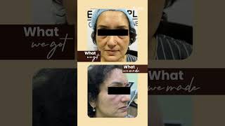 Before & After Skin Treatment Results | Real Patient Transformations | Derma Solutions Bangalore