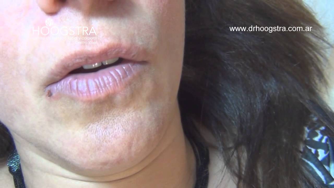 ultrasonido portatil Lesión vascular del labio - Láser Fox (15101)