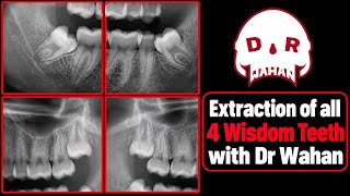 Removing 4 Wisdom Teeth Video- Step by Step