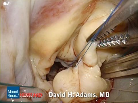 Mitral Valve Repair of Barlow's Valve Disease