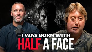 The Man Who Was Born With Half a Face - Joel Whitwell Tells His Incredible Story