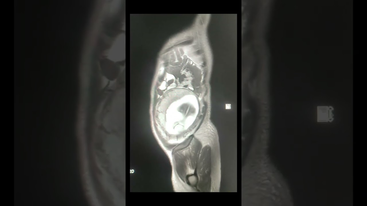MRI Whole Abdomen 