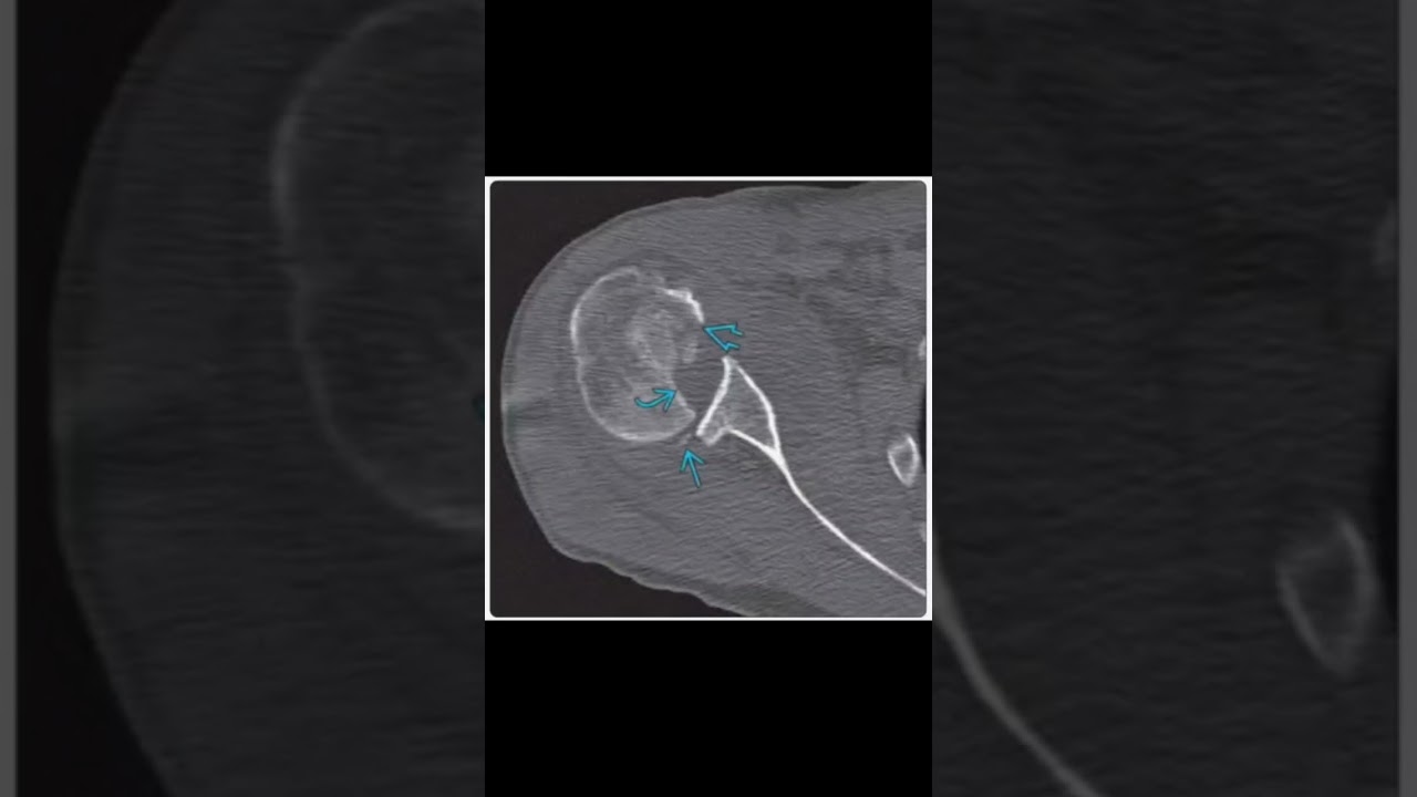 reverse Hill-sachs sign in posterior glenohumeral dislocation 