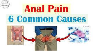 6 Common Causes of Anal (Rectal) Pain That You Should Know