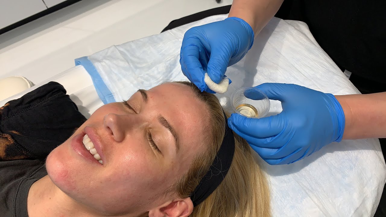 HER SKIN STAYS FLAWLESS WITH REVEPEEL CHEMICAL PEEL FOR ANTI-AGING AND REJUVENATION | Dr. Jason Emer