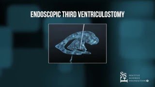 Endoscopic Third Ventriculostomy Animation