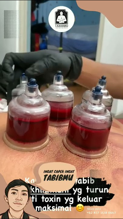 bekam darah tinggi