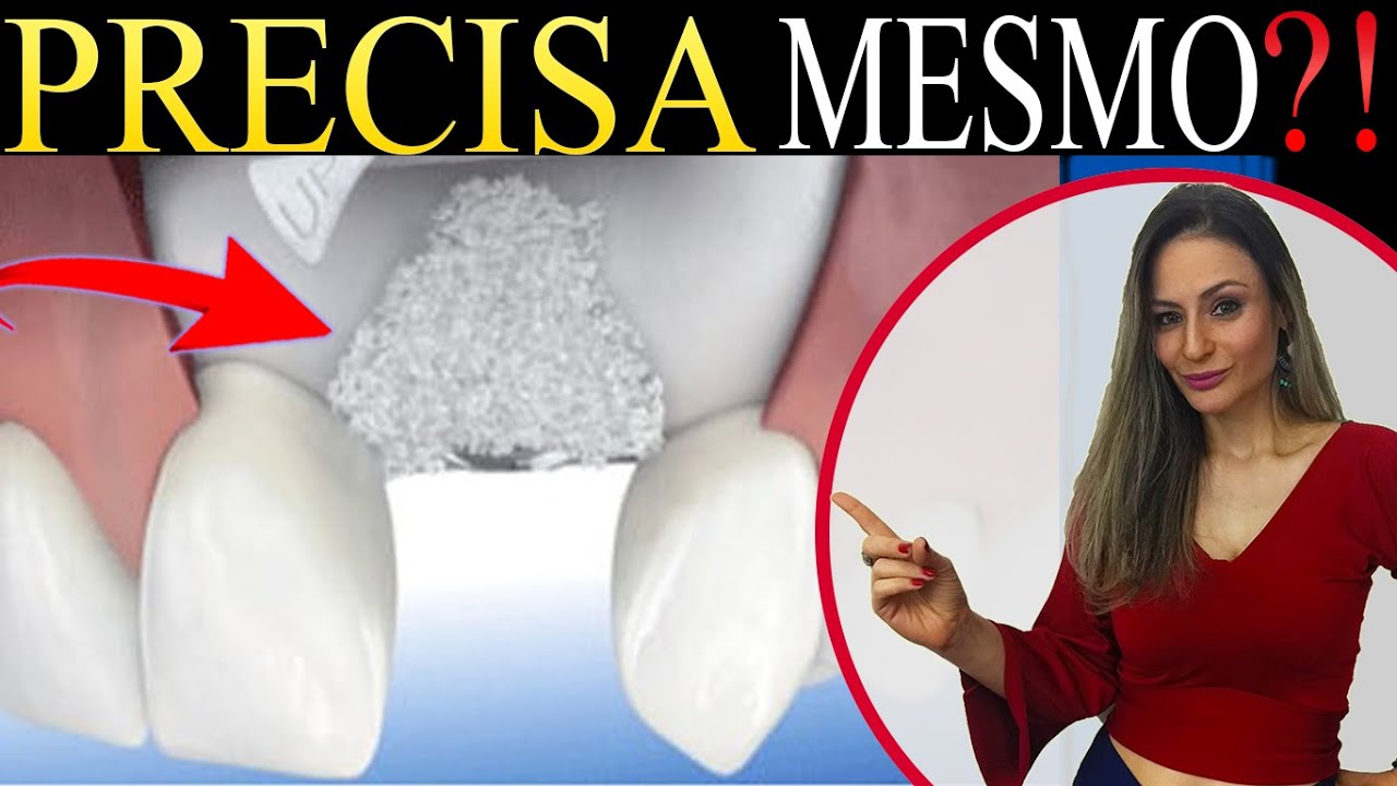 🟢СЮРПРИЗ: Нужна ли мне костная пластика, чтобы поставить зубной имплантат?!