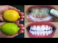 Teeth whitening at home in 3 minutes  how to naturally whiten your yellow teeth  100 effective