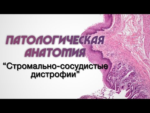 Патологическая анатомия №1 "Стромально-сосудистые дистрофии"