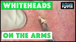 Whiteheads on the arms, caused by chronic sun exposure