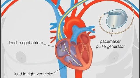 Designing a Rechargeable Pacemaker