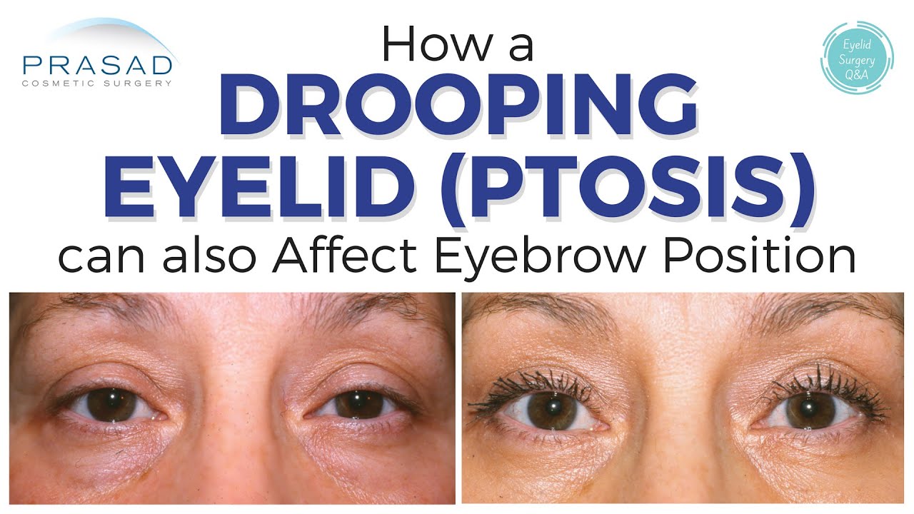 Eyelid Ptosis After Botox
