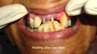 Thumbnail of Dental Implants immediately after teeth extraction - Zolar Dental Diode Laser