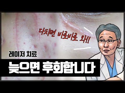 흉터 치료 딱 이것만 기억하세요  [조기 레이저 치료가 중요한 이유]