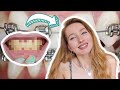 DENTAL JOURNEY | How my Face Changed with Braces, Composite Bonding &amp; Whitening