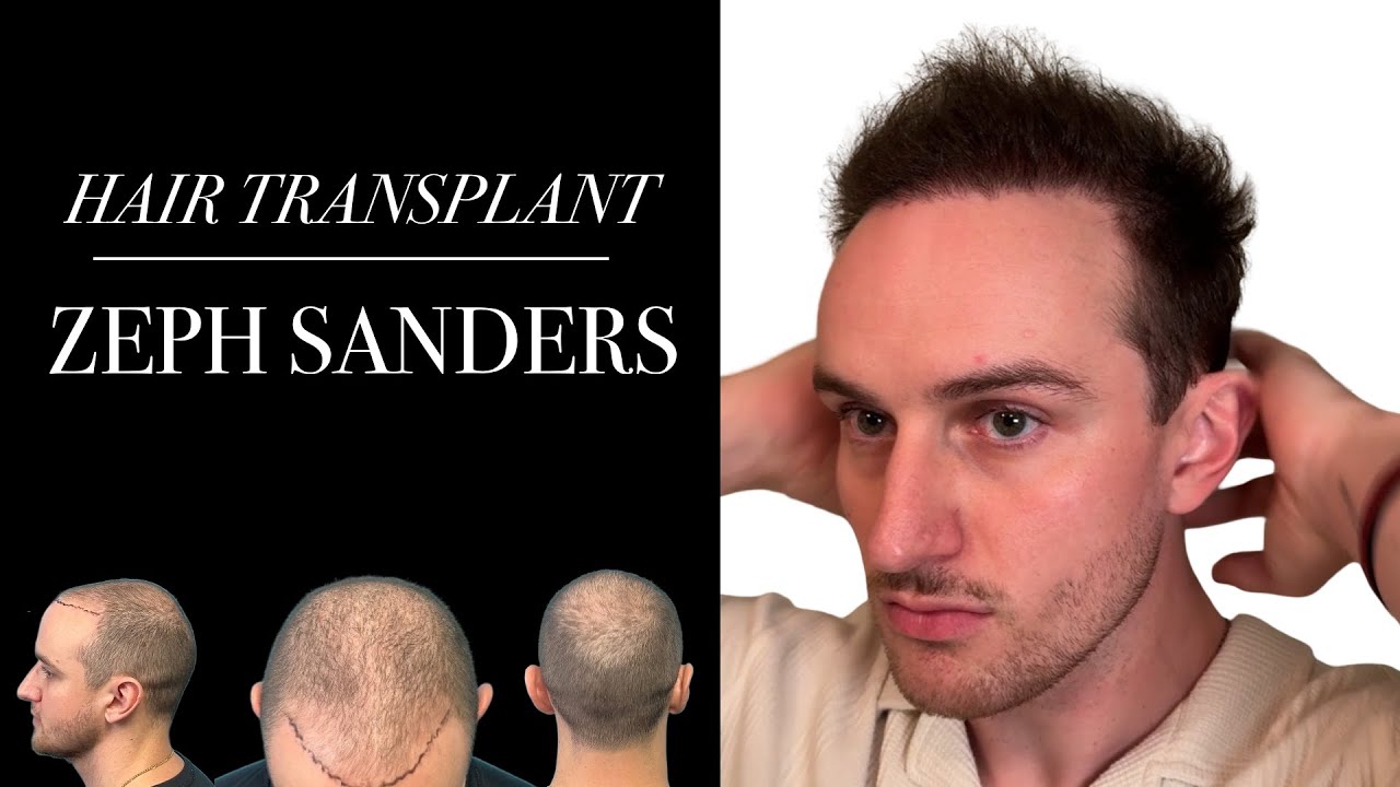 Zeph Sanders Hair Transplant Journey with Dr. Parsa Mohebi at Parsa Mohebi Hair Restoration