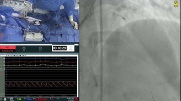 PCI of Long Calcified LAD/D2 Bifurcation using RA and Mini-Crush Technique