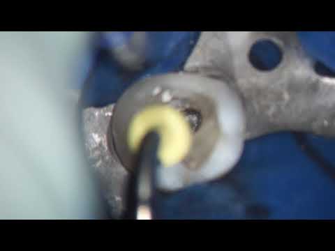 MTA/BEC_monoblock_obturation_technique_by_endodontist_Podolsky