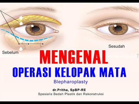 MENGENAL OPERASI KELOPAK MATA