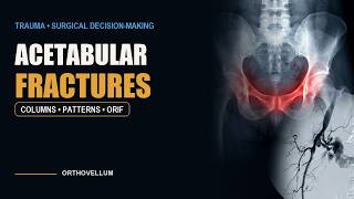 Acetabular Fractures — Columns, Patterns, and Fixation