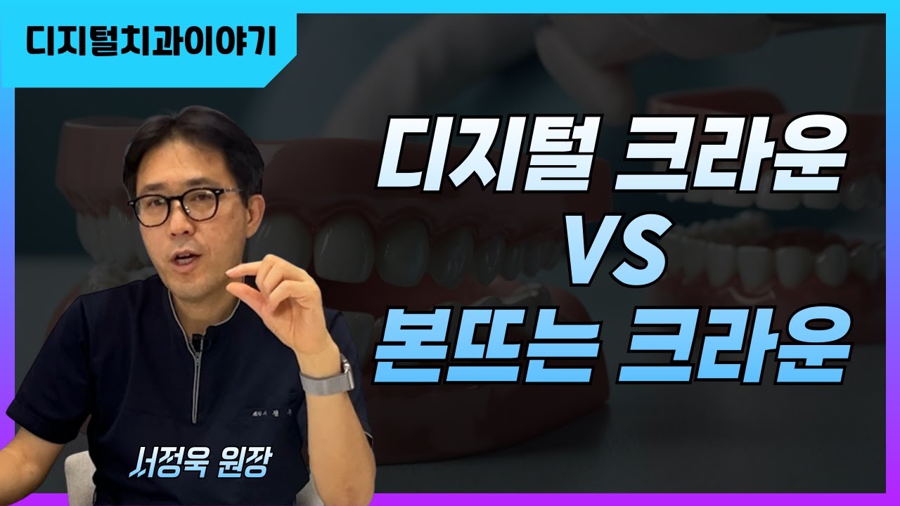 디지털 크라운 VS 본뜨는 크라운 #3D scanner #디지털임플란트 #implantdentistry  #치과의사 #dentist # 3shape