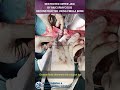 DESTROYED UPPER JAW BY MUCORMYCOSIS RECONSTRUCTED USING FIBULA BONE