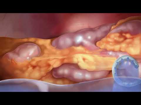 Video: Wat is peritoneaal?