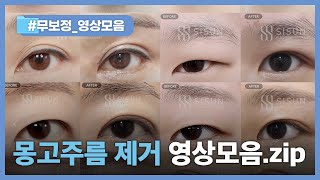 강한 몽고주름 제거 환자 사례모음. zip