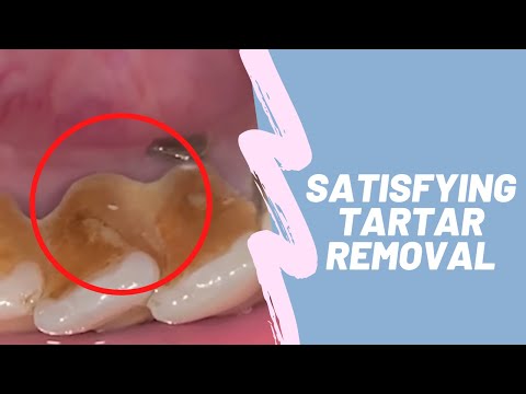 Do you routinely get Scaling your Teeth ?