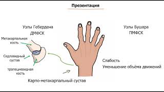 остеоартрит (остеоартроз) ОА  - определение, этиология, патогенез, клиника, диагностика, лечение