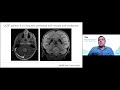 Brain Tumor Genomics/Epigenomics - David A. Solomon, MD, PhD