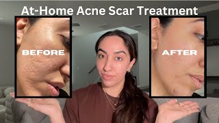 How I Treat My Acne Scars at Home - Before & After Photos!