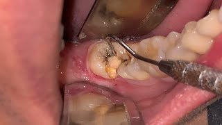 34yo. Male. Odontectomy | Cabut Geraham Bungsu | Dentist | Dokter Gigi Tri Putra