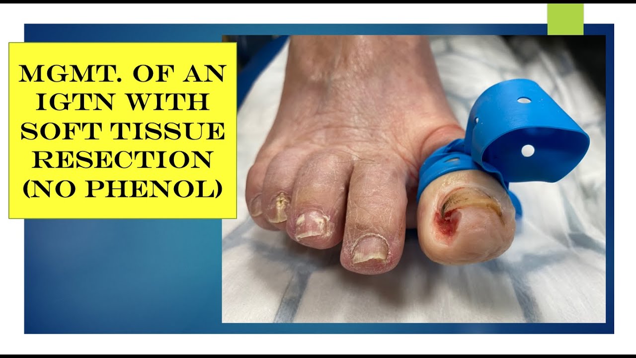 Video Ingrown Toenail Managed By Soft Tissue Resection YouTube video-ingrown-toenail-managed-by-soft-tissue-resection-youtube