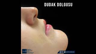 Dudak Dolgusu