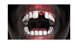 Dental Implant Animation