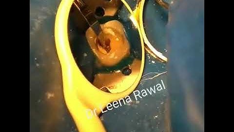 Removal of pulp Stone from ultrasonic scaler tip,an easy and economical way