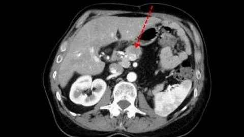 Gold Anchor fiducial marker implantation in abdomen