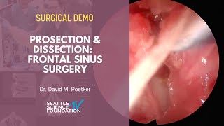 Prosection & Dissection  Frontal Sinus Surgery - David M. Poetker, M.D. , M.A.