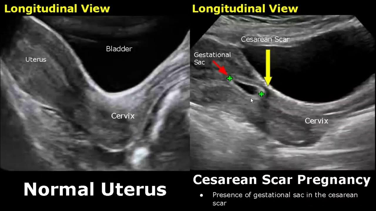c-section-uterus-ultrasound-normal-vs-abnormal-image-appearances