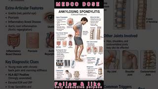 ANKYLOSING SPONDYLITIS Clinical Feature #healthcare #ytshorts #youtubefeed  #trending #nursing