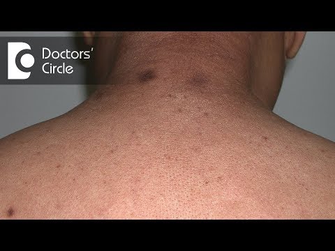 Como gerir progressiva Macular Amiloidose? - Dr. Sachith Abraham