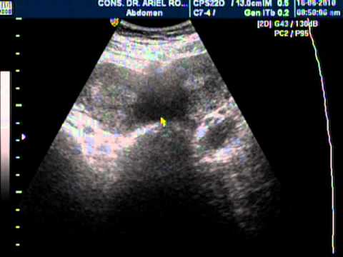 UTERO DOBLE. DR. ARIEL RODRIGUEZ, UNION MEDICA, SANTIAGO, R.D. - YouTube