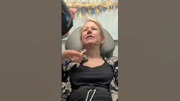 Mastering the Art of Precision: Pre-Surgical Planning for a Revision Facelift, Neck Lift, and Upper