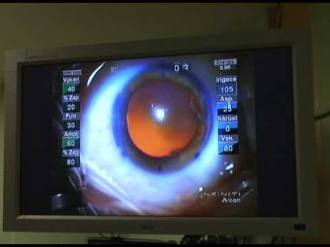 Operace šedého zákalu (katarakty) - jak to probíhá?