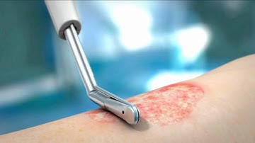 Hydrosurgical Debridement by VERSAJET◊