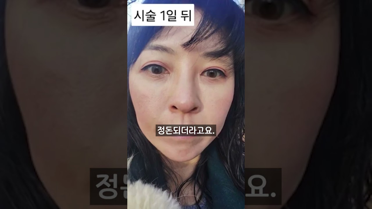 스킨보톡스 받을 때 내성이 걱정된다면