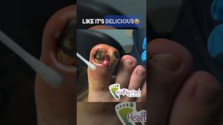 The Devil’s Ingrown Nail popping