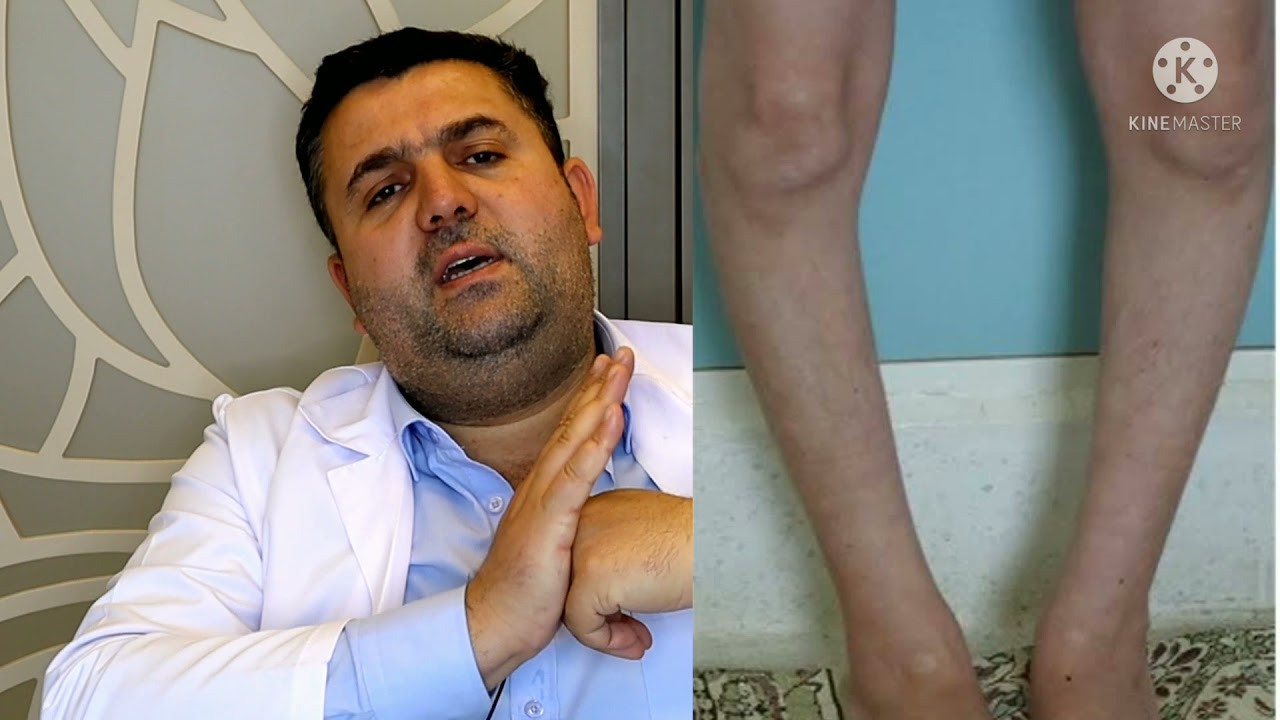 Yük yönlendirme Ameliyatı ( yüksek tibial osteotomi ) bacak düzeltme ameliyatı